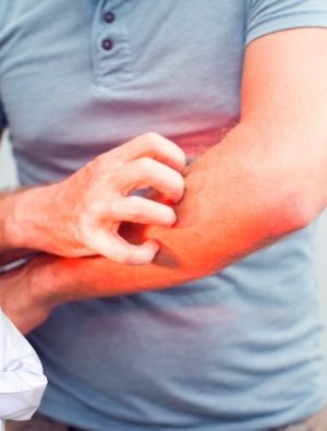 Yaz Aylarında Vücut Mantarı Riskine Dikkat
